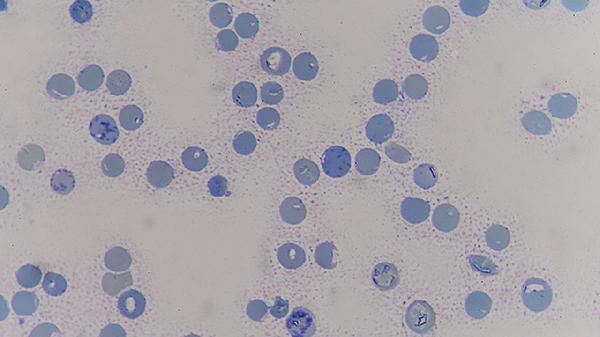 从明年开始，超过52岁以上的癌症患者，一定要做好这4个准备