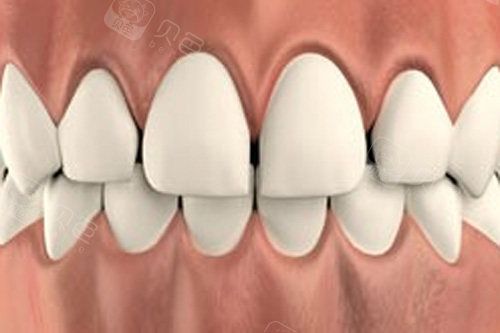 牙齿稀疏示意图