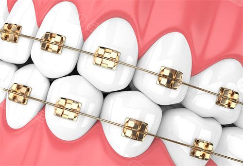 金属牙齿矫正