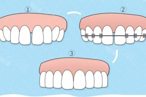 牙齿矫正步骤图