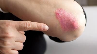 手癣的患者夏天应多吃什么