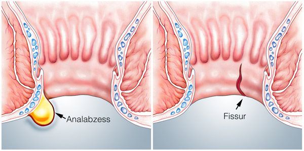 宝宝便秘的诊断标准