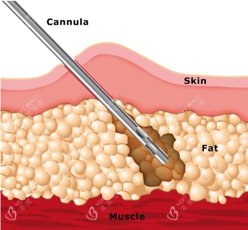 吸脂手术动画演示