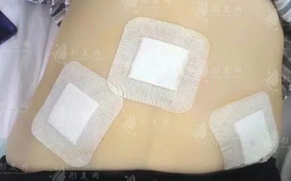 超能电浆抽脂vs传统抽脂怎么选?2026最新技术对比+避坑指南