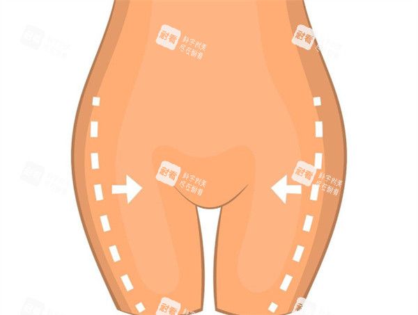 大腿吸脂手术卡通图