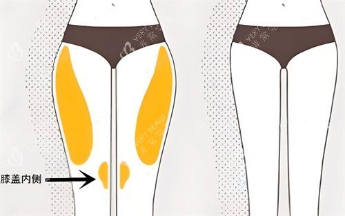 腿部吸脂前后对比