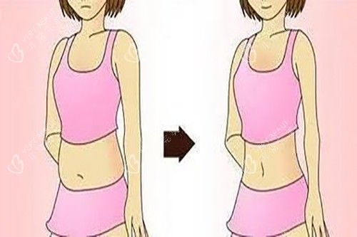 腰腹吸脂示意图卡通