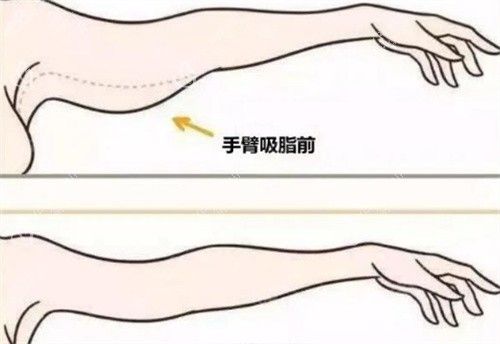 手臂吸脂