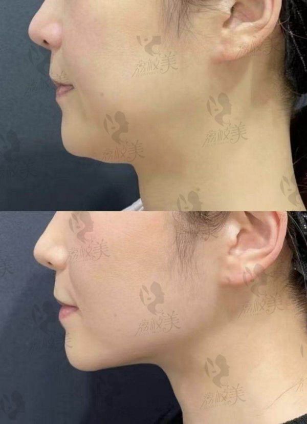 四、哪种方法消除富贵包不易复发？