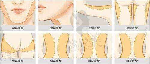三、微创技术消除富贵包是怎么操作的？