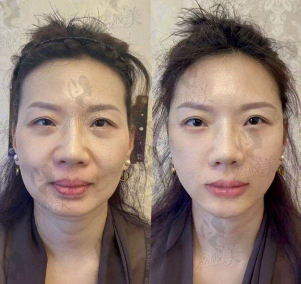 六、消除富贵包后的美好展望