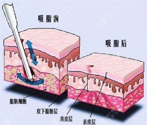 吸脂手术前后对比动画图示
