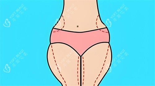 腿部吸脂手术吸脂部位动画图