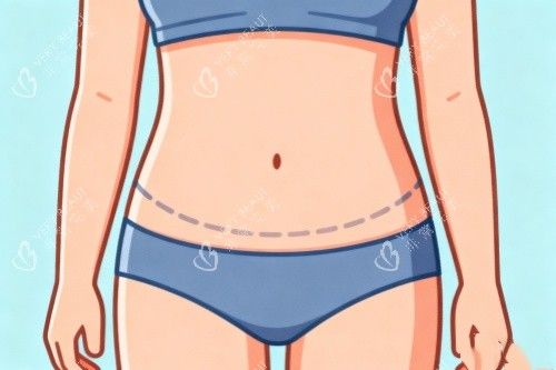 腹部吸脂卡通图一览