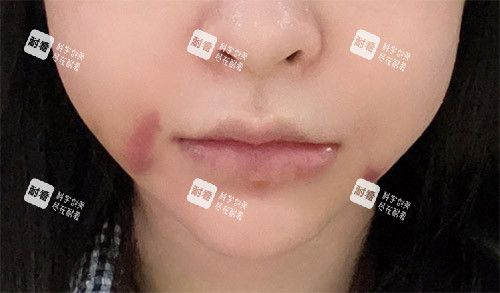 轮廓手术面部肿胀