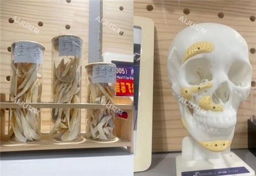 重庆松山医院截骨骨头整理图