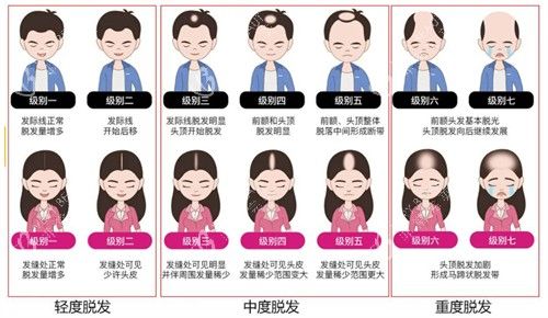 不同程度的脂溢性脱发