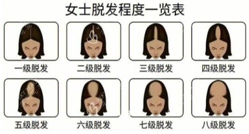 脱发等级