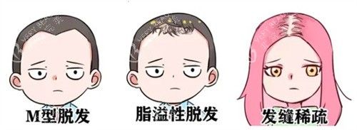 脱发种类