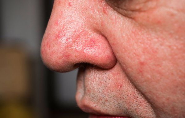 用了去角質(zhì)臉部刺痛發(fā)紅