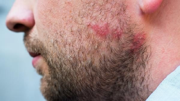 脸部肌肉下垂怎样变得紧致