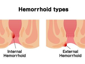 吃了碧生源便血怎么辦