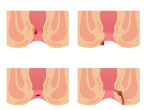 吃了碧生源便血怎么辦