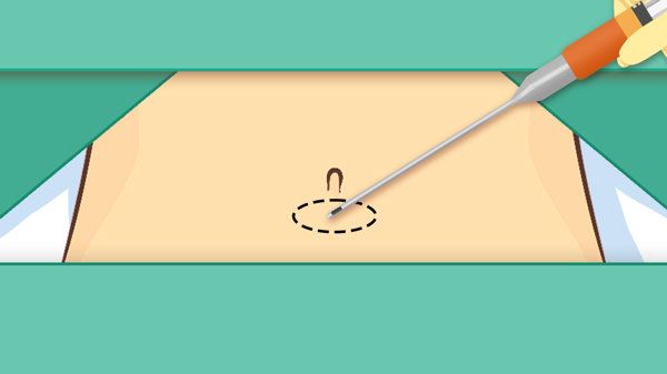 抽脂美容减肥术怎么做