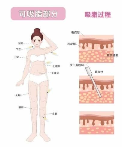 三、上海薇琳张怀军吸脂手术全记录：从面诊到拆线的真实体验