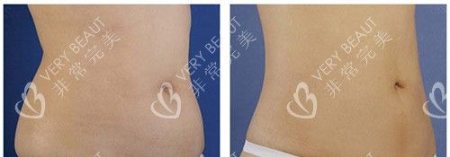 腰腹吸脂前后对比