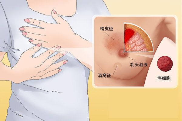 腹部抽脂减肥多久恢复正常生活