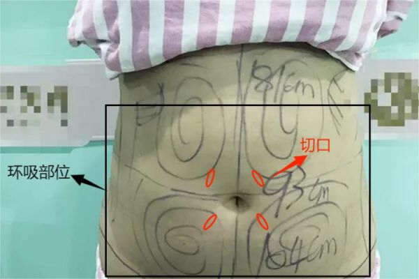 腰腹部环吸部位示意图