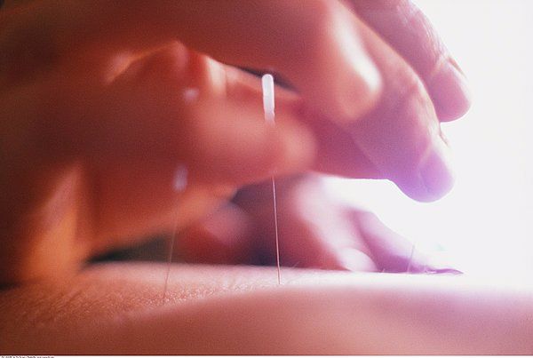 西安针灸减肥和埋线双眼皮