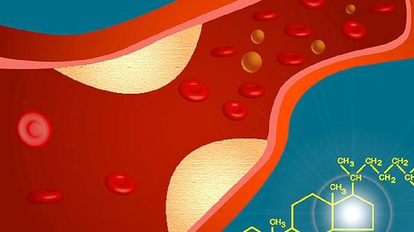 医生直言：血管斑块者想活过90，50岁后7件事就不要再碰了