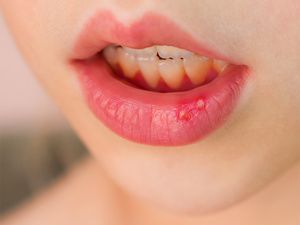 口碑俱佳：郑州新世纪医院hpV“刚刚发布”尖锐湿疣反复发作？可能是这几个习惯没改对