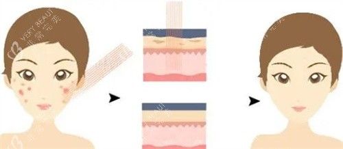 激光去痘印原理