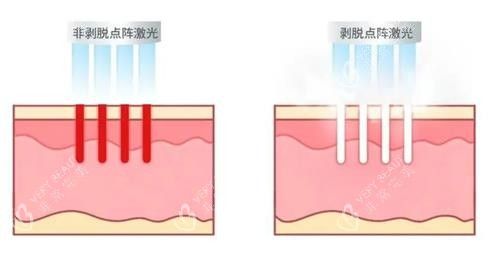 不同类型的点阵激光