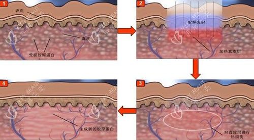 点阵激光作用于皮肤层次示意图