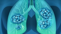 创新药芦比替定获权威推荐！小细胞肺癌患者将迎来新选择