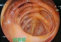 惊了！医生：我仿佛在患者体内见到了巨大「蜂窝」