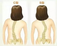 【健康】“S型”身材不一定是好事，还有可能得了这种病，快自查！