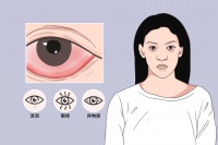 过敏性结膜炎