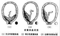 前置胎盘超声新标准...