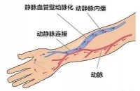 动静脉内瘘成形术术后功能锻炼