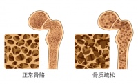 【科学就医】骨折后功能锻炼的必要性