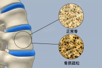 骨质疏松定义