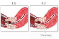 不完全流产