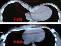 【新闻速递】“挺”起胸膛，自信生活！胸科医院独创胸壁矫正技术，重塑“好身材”