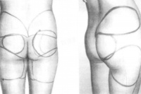 臀部吸脂手术全过程