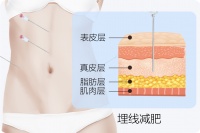 埋线能减肥吗，大概几天能瘦